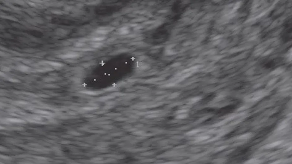 Ultrasound Scans: Track Your Pregnancy Week-by-week