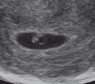 Ultraschallbilder Einer Schwangerschaft