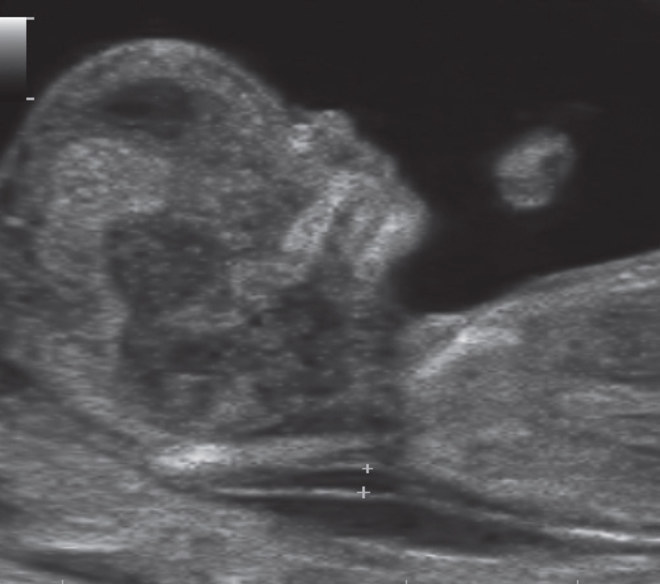 Junge ultraschall oder anzeichen Wird es