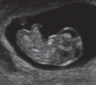 Schwangerschaftswoche ultraschall siebte SSW 7:
