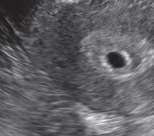 Ultraschallbilder Einer Schwangerschaft