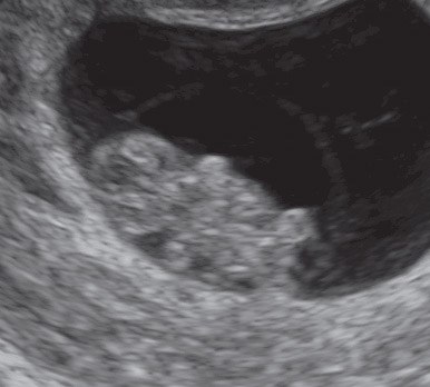 Brauner zervixschleim schwanger