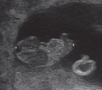 Siebte schwangerschaftswoche ultraschall