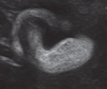Brauner zervixschleim schwanger