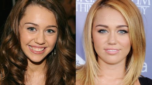 Celebrity Rhinoplasty Before And After
