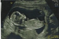 1 Echo Garcon Ou Fille