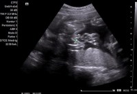 Ultraschall Geschlecht Erkennen