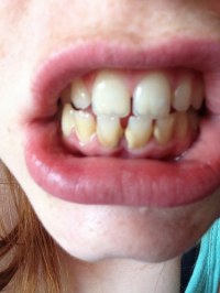 Dents Jaune Que Faire Photo