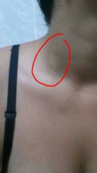 bulto en cuello que duele