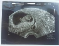 Hellbraune schmierblutung frühschwangerschaft