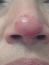 Macchia Rossa Sul Naso Da Due Mesi Macchia Rossa Sul Naso Da Due Mesi