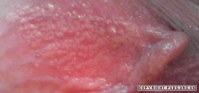 Granos enterrados en los labios mayores