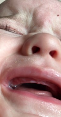 Puntino Bianco Sulla Gengiva Denti