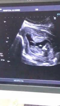 Sexo Bebe Tuberculo Genital