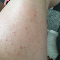 Prurito Gambe Braccia