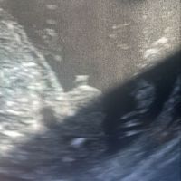 Echographie Sexe De Bebe A 17 Sa