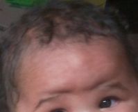 Deformation Du Crane De Ma Fille De 4 Mois Et Demi