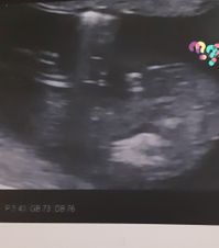 Interrogation Sexe De Bebe Echo De Semaines