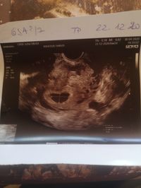 Absence De Rythme Cardiaque Echo 10 Sem 2