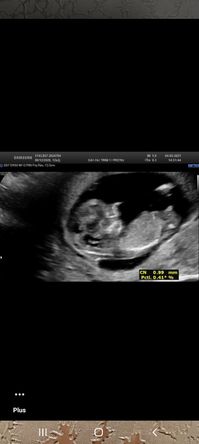 Avis Fille Ou Garcon A 11 Semaines 5 Jours D Amenorrhee