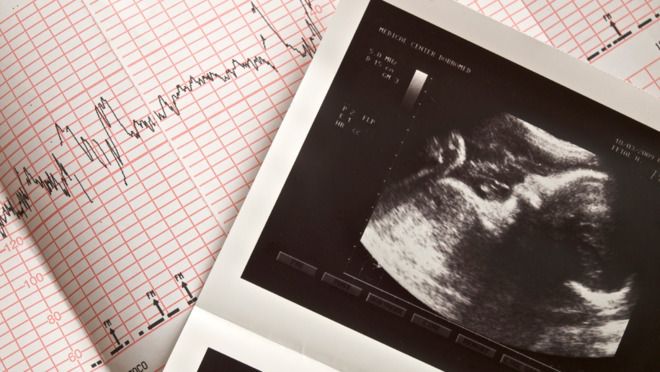 L Improbable Echographie D Un Bebe Ressemblant A Un Oiseau