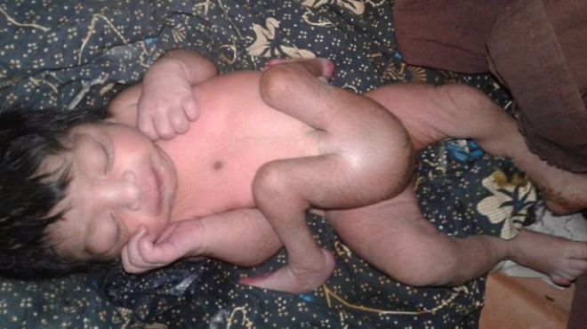 Malformation Le Petit Indien Ne Avec Quatre Jambes Et Deux Penis A Ete Opere