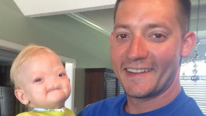 Le Petit Garcon Ne Sans Nez Est Decede A L Age De Deux Ans