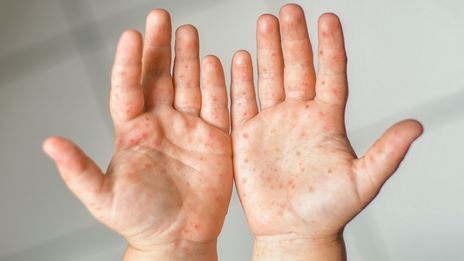 Alerte A L Epidemie De Pieds Mains Bouche En France Comment Proteger Mon Bebe