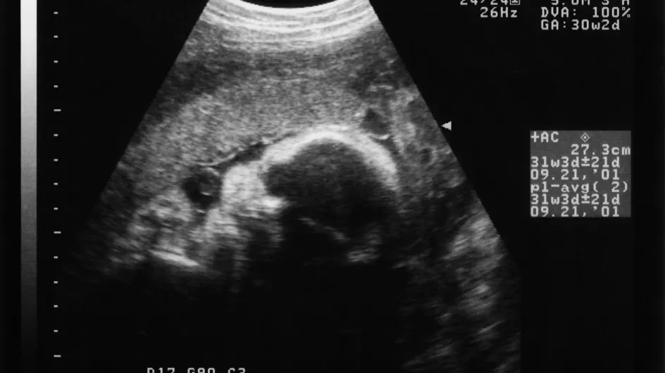 Un bébé sauvé grâce à une opération in utero en Espagne