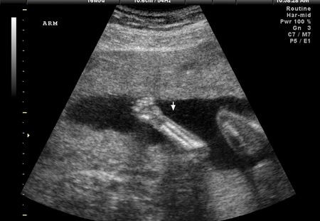 Echographie de grossesse : les 3 échographies de la grossesse