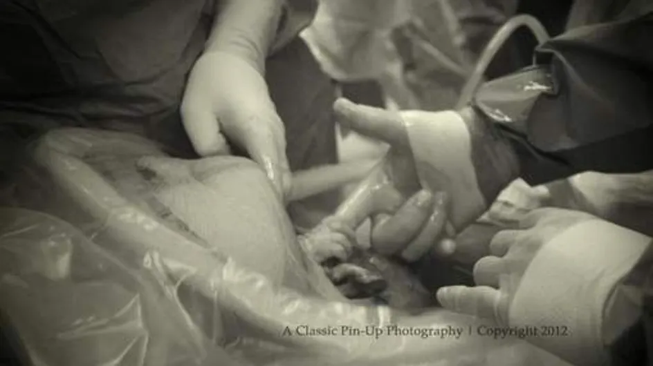 Un bébé serre le doigt du docteur avant même d'être sorti du ventre de sa mère ! (Photos)
