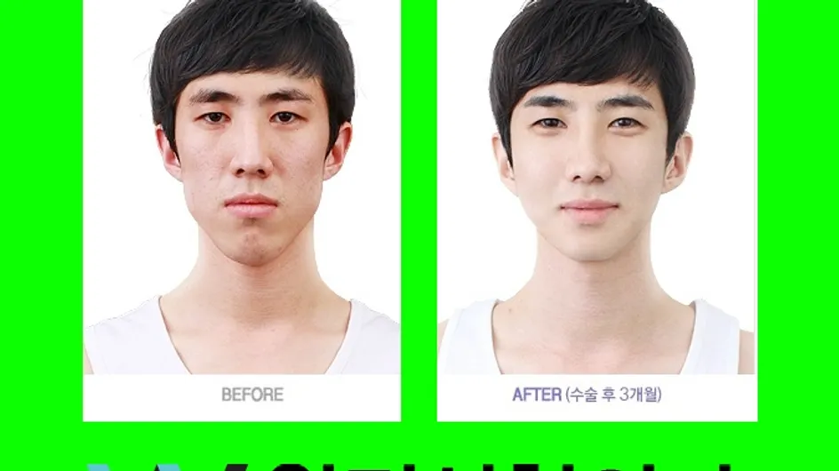 Chirurgie esthétique : Des avant/après incroyables en Corée (Photos)