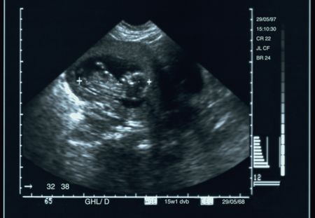 Échographie de grossesse : quand, à quelle fréquence et comment cela se  passe ? : Femme Actuelle Le MAG