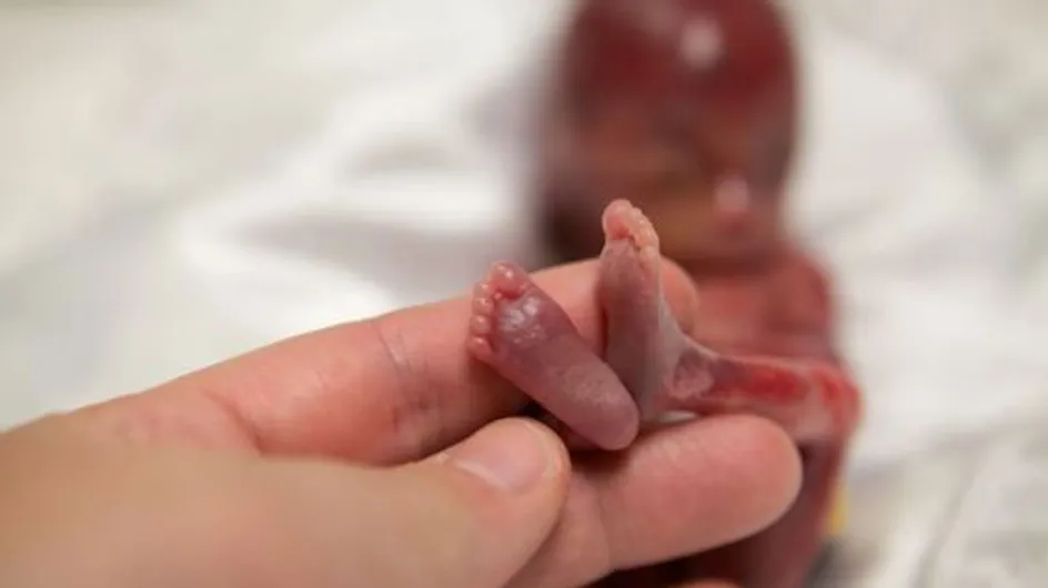 Las impactantes fotos de un bebé de 19 semanas reabren el debate sobre el aborto