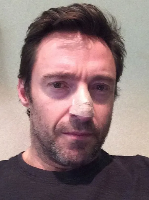 Hugh Jackman confiesa en Twitter que sufre cáncer de piel