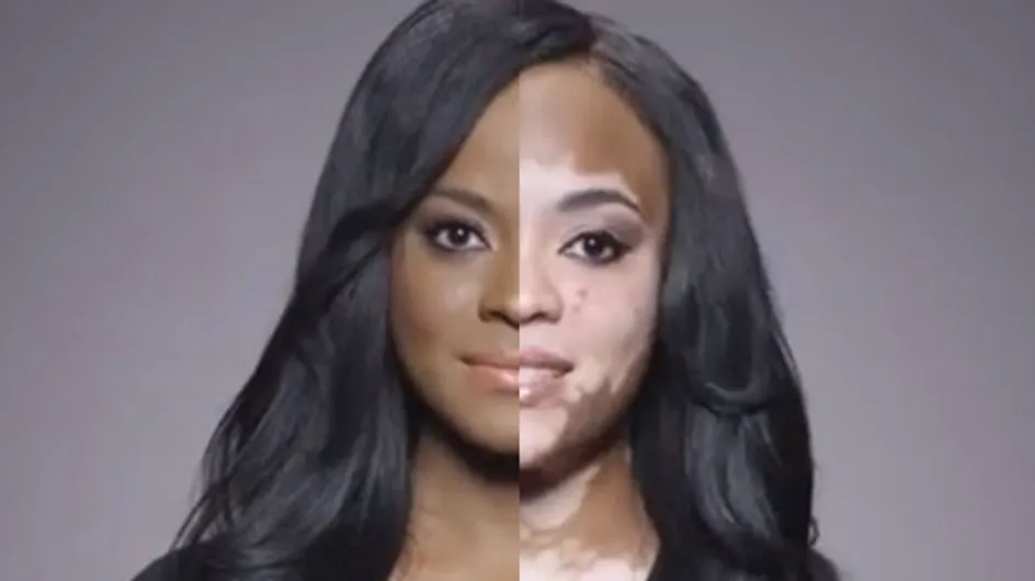 L’après/avant courageux et stupéfiant d’une femme contrainte de cacher sa maladie de peau sous du maquillage (vidéo)