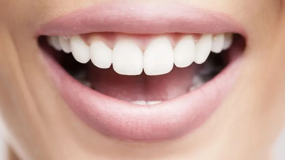 Sensu's Smile Makeover! The Ultimate Teeth Whitening Treatment