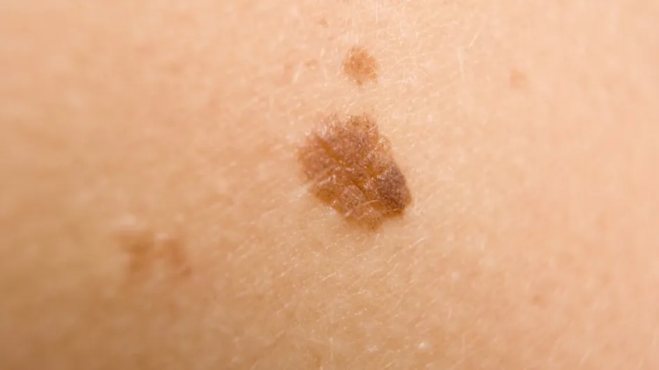 Los lunares, factor de riesgo para sufrir melanomas