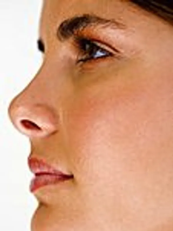 Nose job (rhinoplasty)