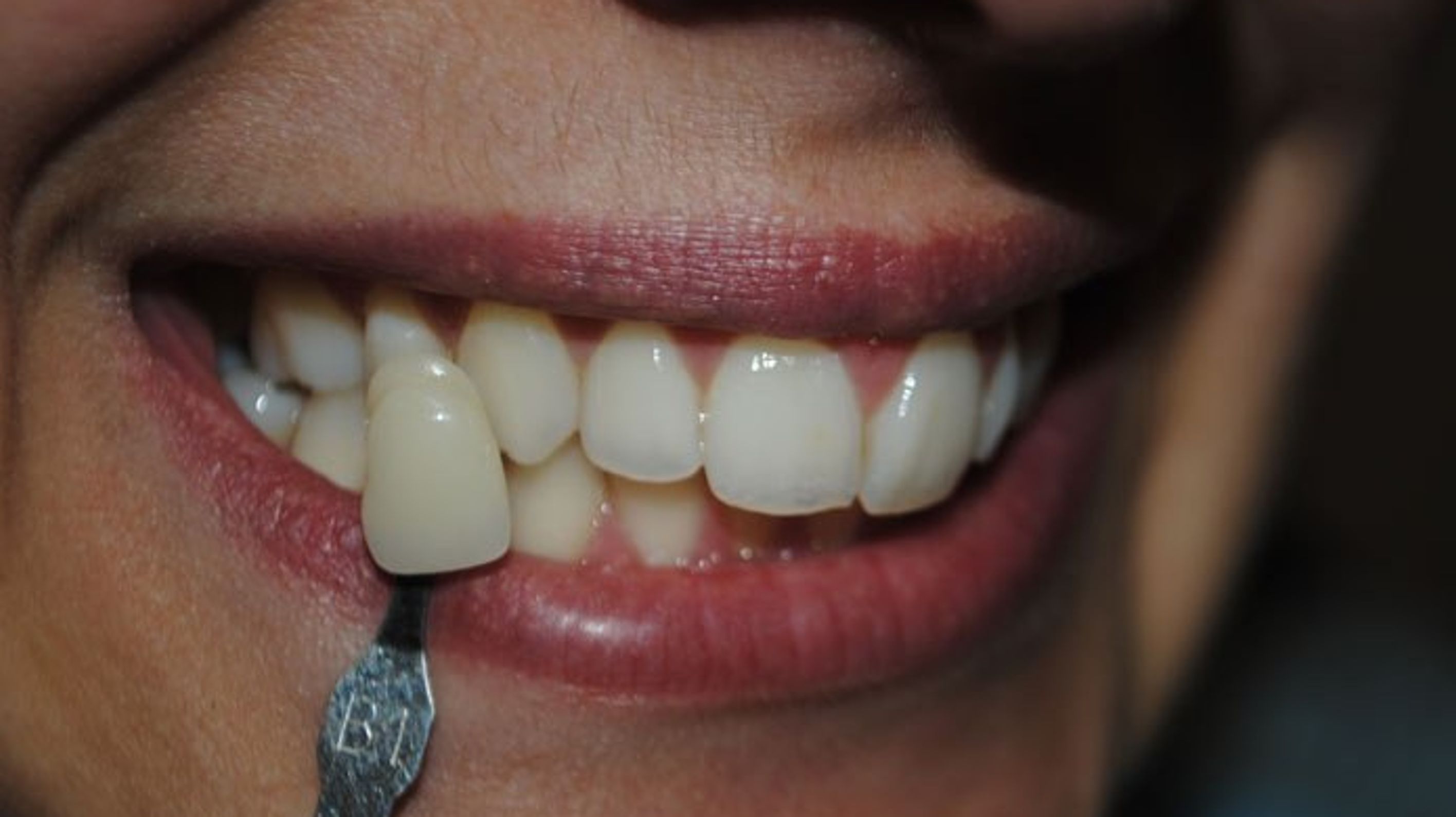 Cheap white teeth whitening