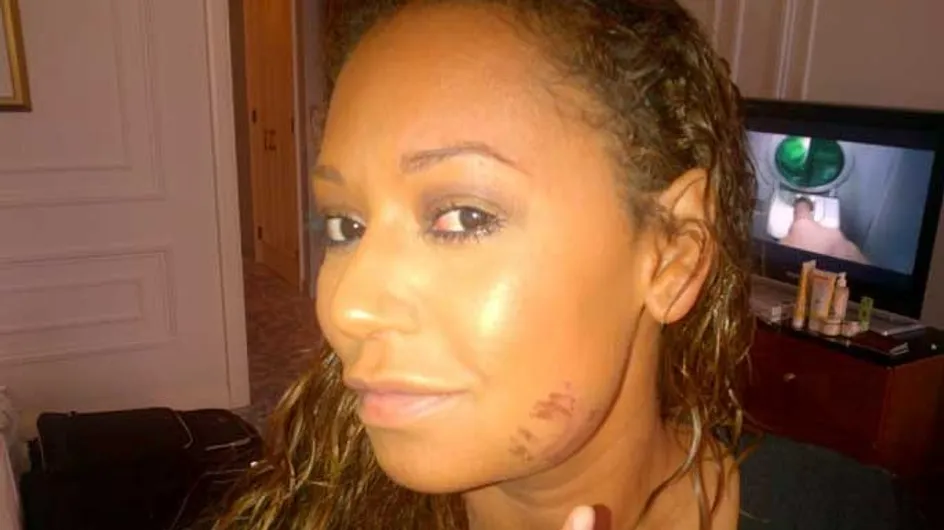 Mel B injured after running in seven-inch Louboutins
