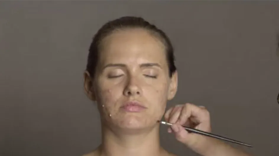 How Adult Acne Really Feels: Model Transforms Herself With Makeup To Find Out