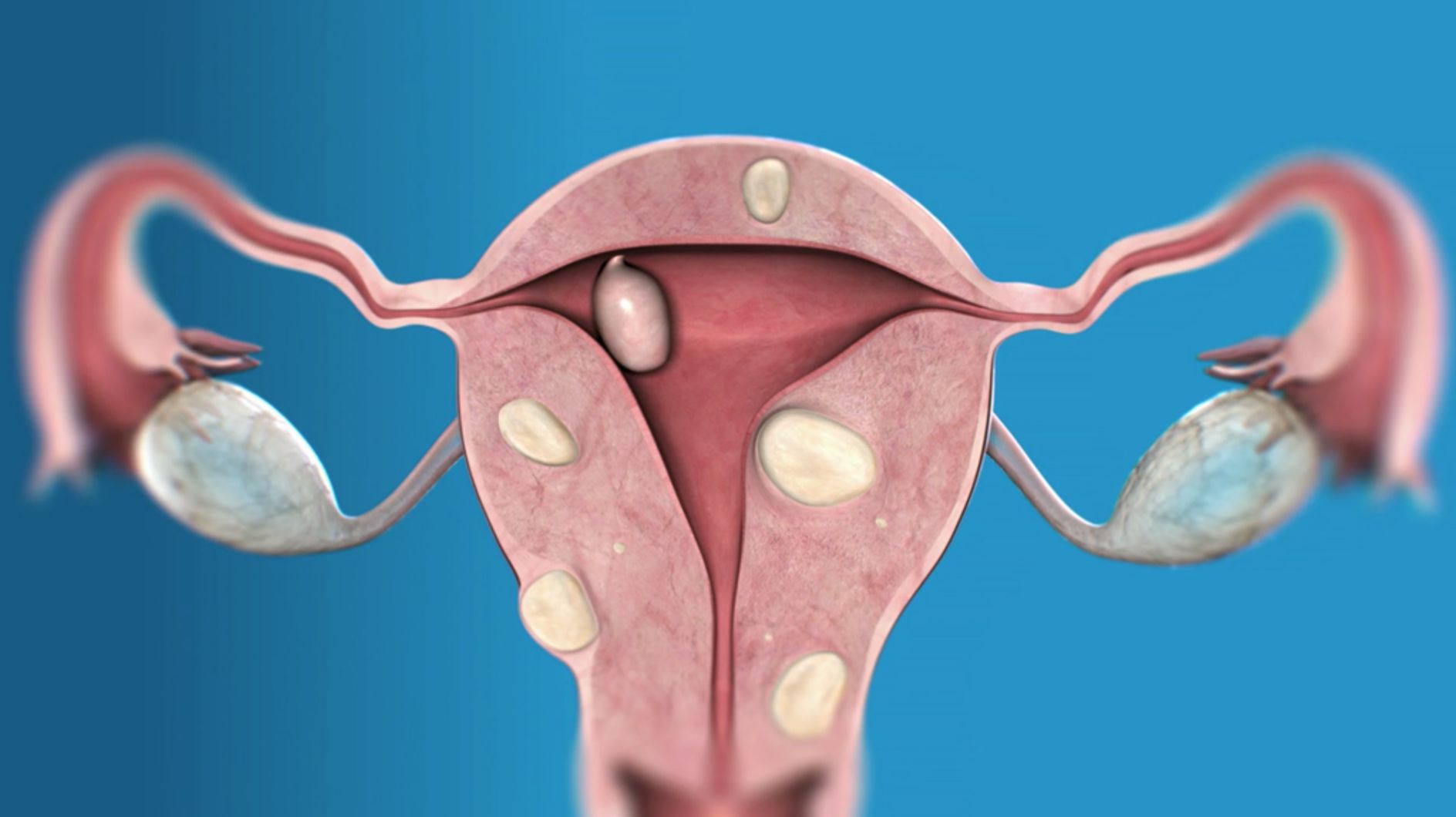 Fibroma uterino: terapie alternative
