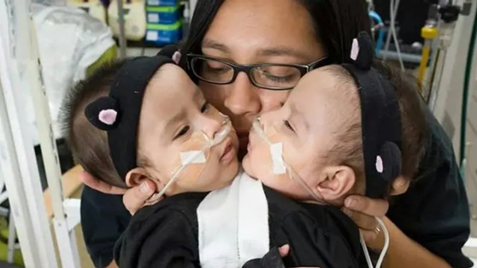Deux soeurs siamoises survivent à une opération très risquée pour les séparer