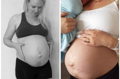 32. SSW vs. 24 Stunden nach der Geburt