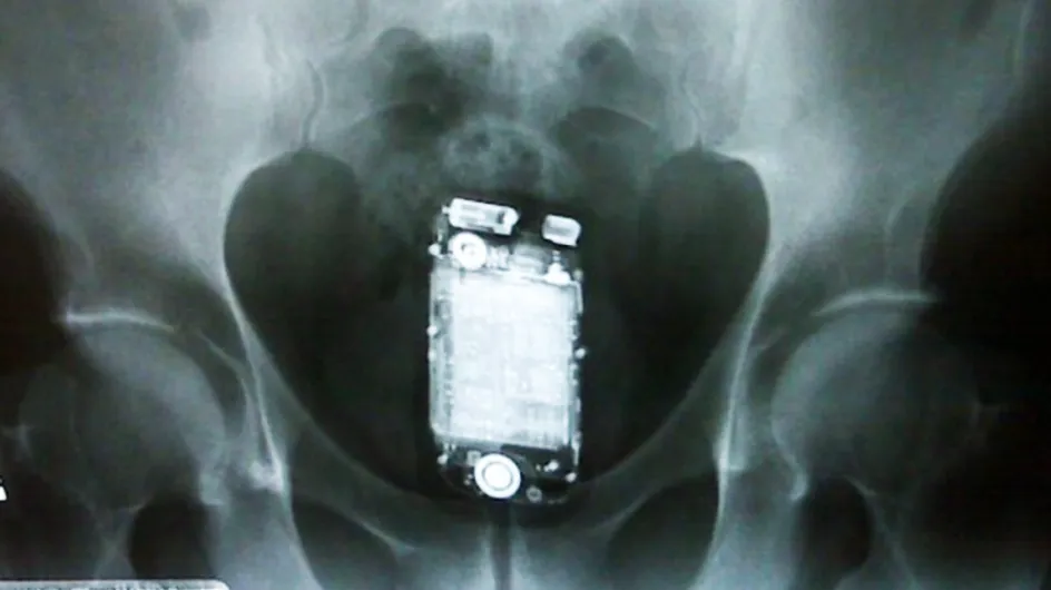 Los 24 objetos más raros encontrados, dentro de una persona, al hacer una radiografía