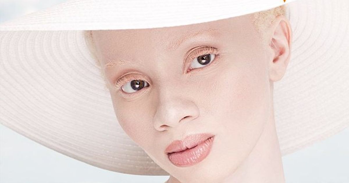 7 modelli albini che hanno conquistato il mondo della moda