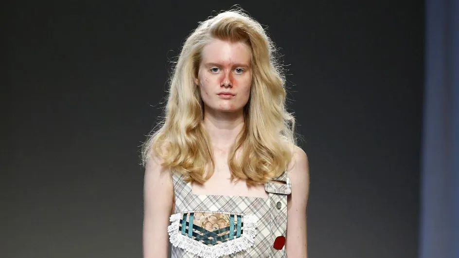 Crise d'acné sur le podium de la fashion week milanaise