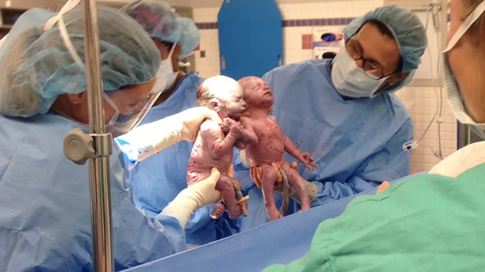 Estas gemelas monoamnióticas que nacieron dándose la mano ¡son inseparables!
