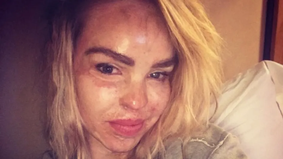 La femme de la semaine : Katie Piper, défigurée à l'acide elle s'indigne contre les make-up d'Halloween